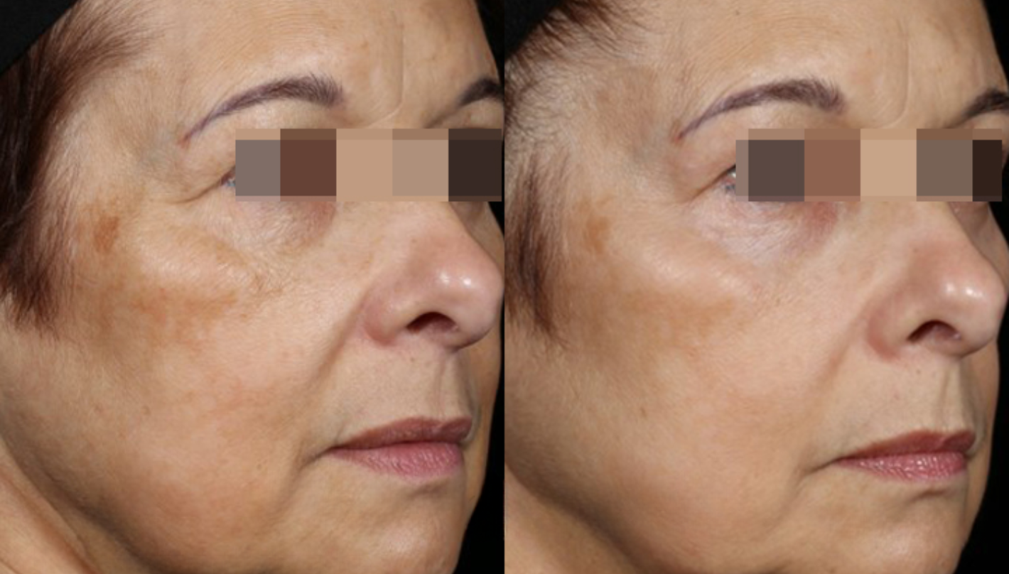 Pico Genesis Before and After Revive Medical Spa Fayetteville