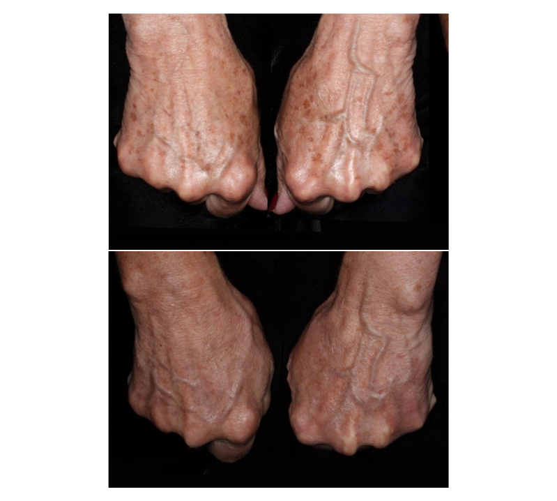 Pico Genesis Before and After Revive Medical Spa Fayetteville