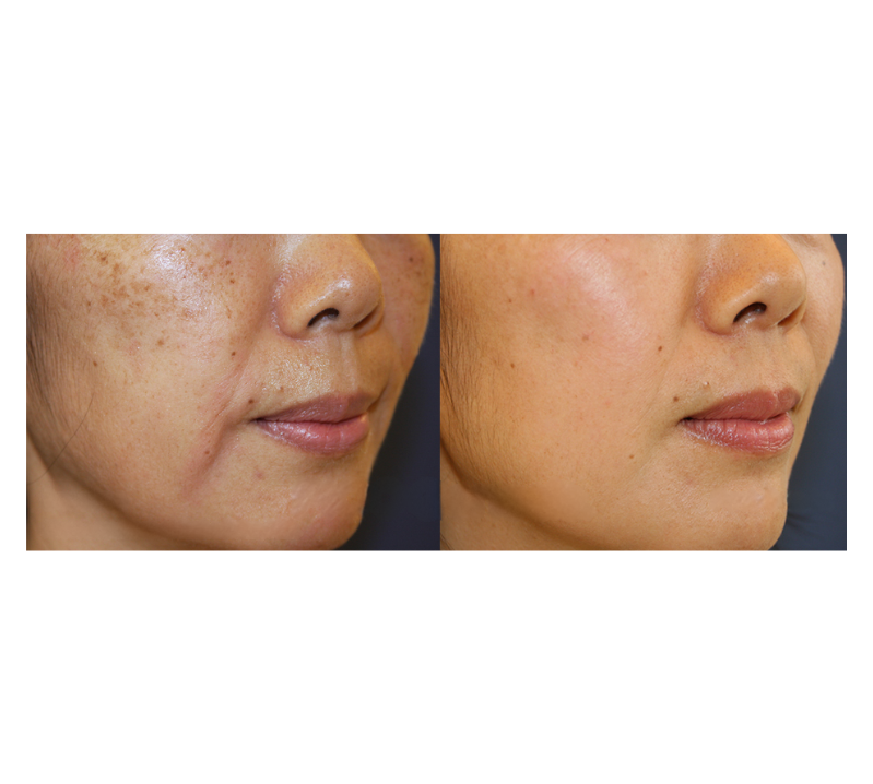 Pico Genesis Before and After Revive Medical Spa Fayetteville