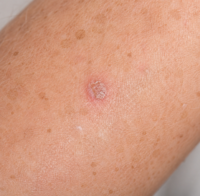 Squamous Cell Carcinoma Advanced Dermatology & Skin Cancer Center