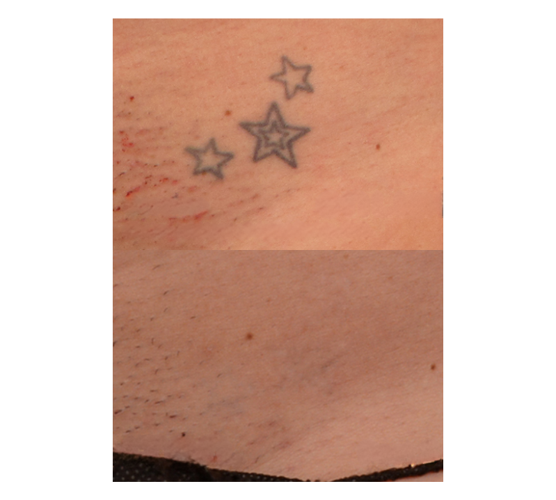 Laser Tattoo Removal Complete Before and Aftter Revive Medical Spa Fayetteville