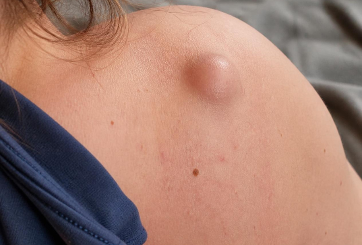 What is a cyst