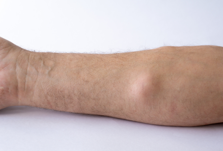 What is a lipoma